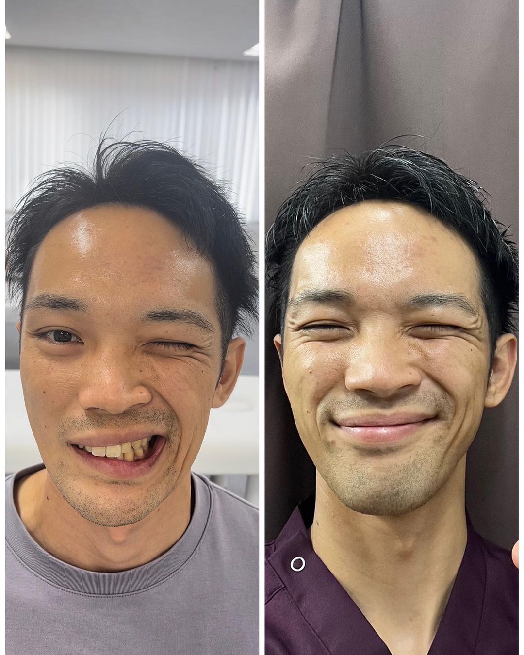 顔面神経麻痺 症例画像