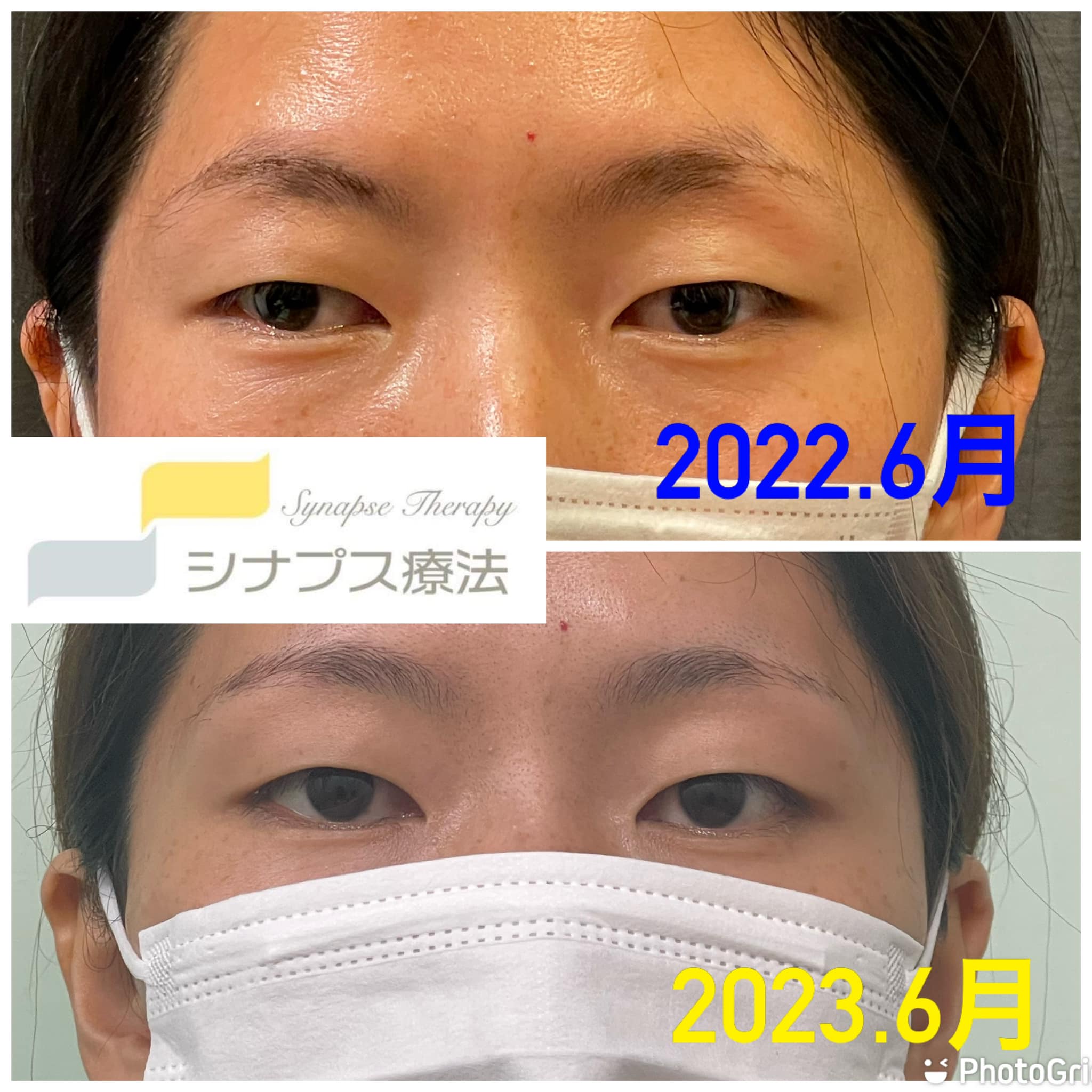 斜視改善 症例画像